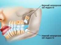 О зубах мудрости