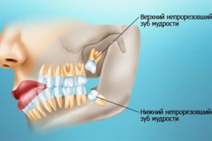О зубах мудрости